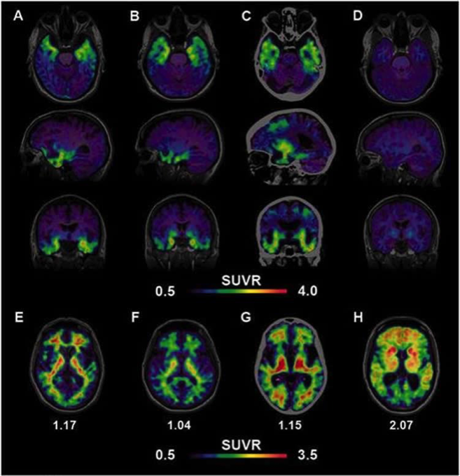 Болезнь Альцгеймера теперь можно увидеть на ПЭТ